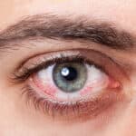 A close up of a man's eye with the words hayfever.